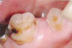 ToothWear1.jpg