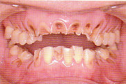 ToothWear3.jpg