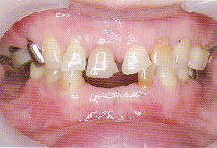 ToothWear4.jpg