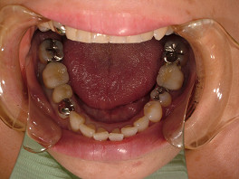 奥隣の白い歯は以前に金属をはずしてメタルボンドを装着しています