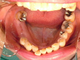右下は2本歯がない状態で4番目の歯も動いています