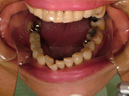 白いセラミックの歯（メタルボンド）
